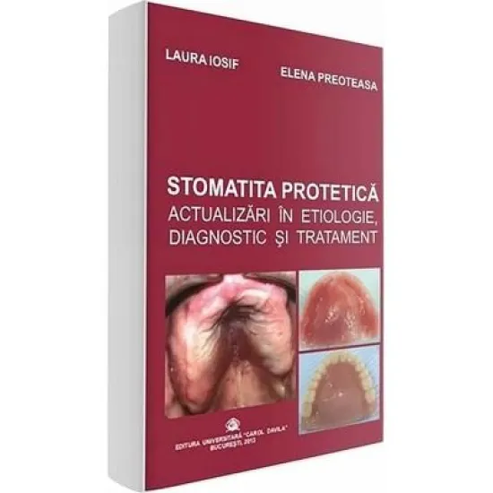 Stomatita protetica. Actualizari in etiologie, diagnostic si tratament - Laura Iosif Stomatita protetica. Actualizari in etiologie, diagnostic si tratament - Laura Iosif